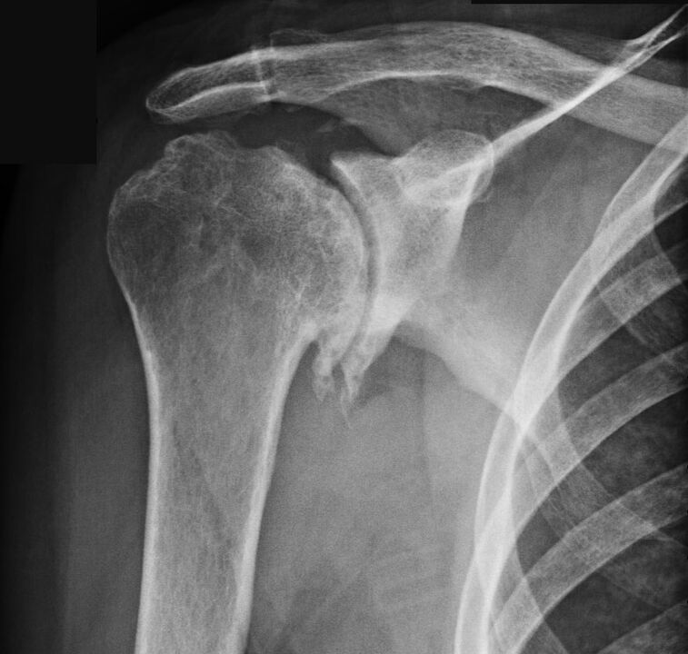 La radiographie a montré une arthrose de l'épaule. 