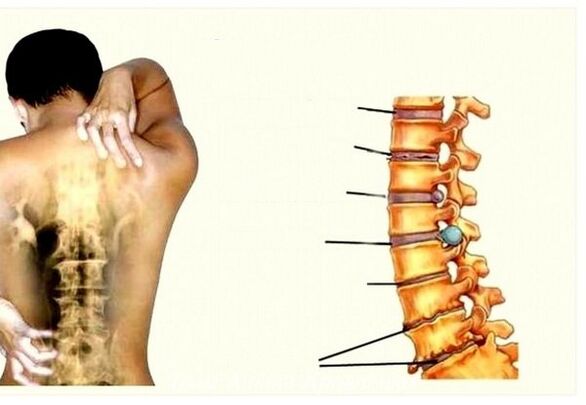 Étapes de l'ostéochondose cervicale