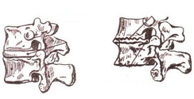 Étapes du développement de l'ostéochondrose cervicale