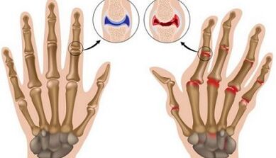Les principales différences d'arthrite et d'arthrose