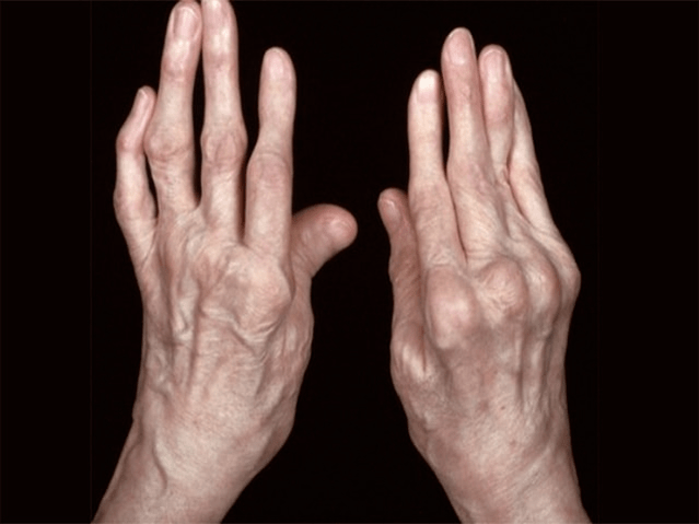 Arthrite comme cause du bout des doigts au bout des doigts