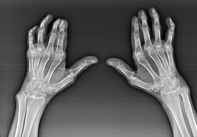 Diagnostic des doigts
