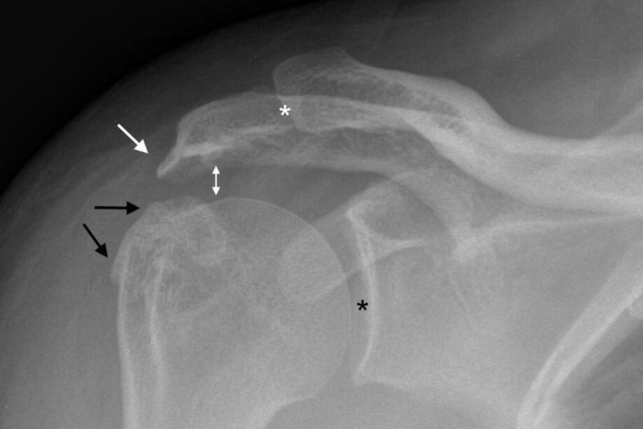 arthrose de l'articulation de l'épaule à la radiographie