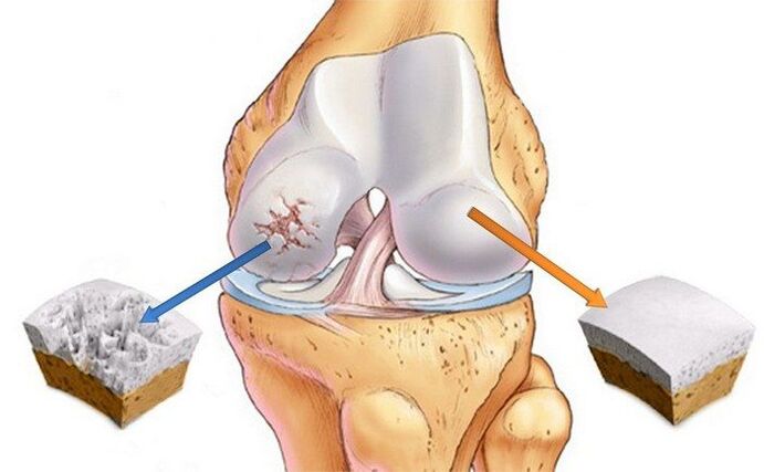 Articulations saines et arthritiques.