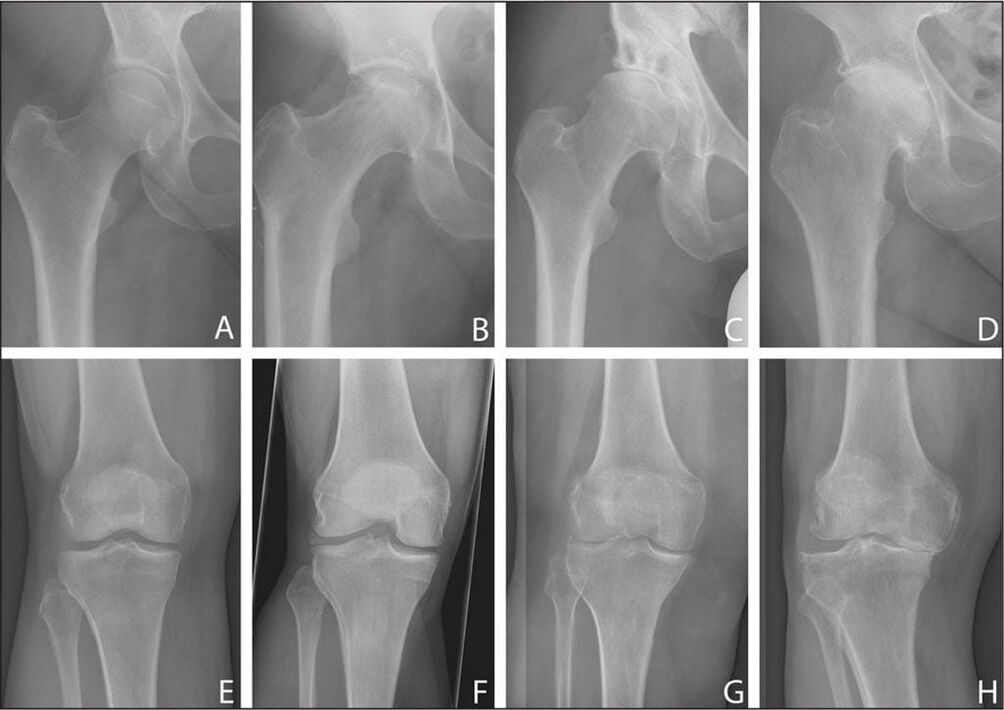 Stades de développement de l'arthrose articulaire sur une radiographie.
