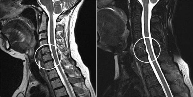 IRM du rachis cervical avec signes d'ostéochondrose.